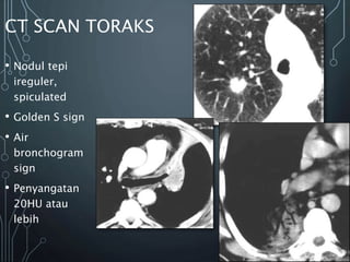 CT SCAN TORAKS
• Nodul tepi
ireguler,
spiculated
• Golden S sign
• Air
bronchogram
sign
• Penyangatan
20HU atau
lebih
 