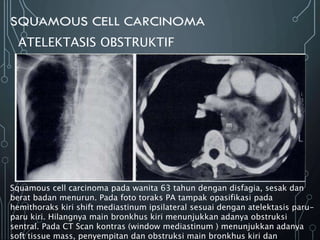 ATELEKTASIS OBSTRUKTIF
Squamous cell carcinoma pada wanita 63 tahun dengan disfagia, sesak dan
berat badan menurun. Pada foto toraks PA tampak opasifikasi pada
hemithoraks kiri shift mediastinum ipsilateral sesuai dengan atelektasis paru-
paru kiri. Hilangnya main bronkhus kiri menunjukkan adanya obstruksi
sentral. Pada CT Scan kontras (window mediastinum ) menunjukkan adanya
soft tissue mass, penyempitan dan obstruksi main bronkhus kiri dan
 
