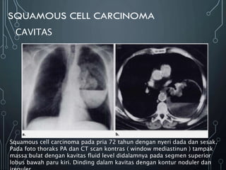 CAVITAS
Squamous cell carcinoma pada pria 72 tahun dengan nyeri dada dan sesak.
Pada foto thoraks PA dan CT scan kontras ( window mediastinun ) tampak
massa bulat dengan kavitas fluid level didalamnya pada segmen superior
lobus bawah paru kiri. Dinding dalam kavitas dengan kontur noduler dan
 