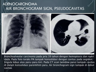 AIR BRONCHOGRAM SIGN, PSEUDOCAVITAS
Bronchoalveolar carcinoma pada pria 39 tahun dengan hemoptosis dan nyeri
dada. Pada foto toraks PA tampak konsolidasi dengan cavitas pada segmen
lingula lobus atas paru-paru kiri. Pada CT scan (window paru) tampak cavitas
di dalam konsolidasi parenkhim paru. Air bronchogram sign tampak di dekat
cavitas
 