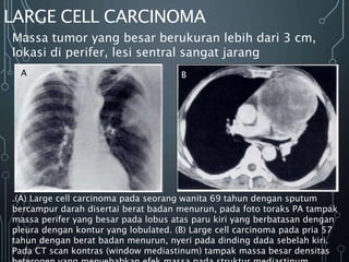 LARGE CELL CARCINOMA
Massa tumor yang besar berukuran lebih dari 3 cm,
lokasi di perifer, lesi sentral sangat jarang
.(A) Large cell carcinoma pada seorang wanita 69 tahun dengan sputum
bercampur darah disertai berat badan menurun, pada foto toraks PA tampak
massa perifer yang besar pada lobus atas paru kiri yang berbatasan dengan
pleura dengan kontur yang lobulated. (B) Large cell carcinoma pada pria 57
tahun dengan berat badan menurun, nyeri pada dinding dada sebelah kiri.
Pada CT scan kontras (window mediastinum) tampak massa besar densitas
A B
 