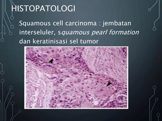 HISTOPATOLOGI
Squamous cell carcinoma : jembatan
interseluler, squamous pearl formation
dan keratinisasi sel tumor
 