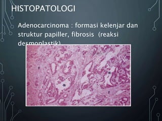 HISTOPATOLOGI
Adenocarcinoma : formasi kelenjar dan
struktur papiller, fibrosis (reaksi
desmoplastik)
 