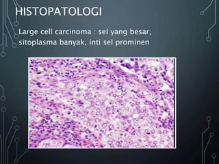 HISTOPATOLOGI
Large cell carcinoma : sel yang besar,
sitoplasma banyak, inti sel prominen
 