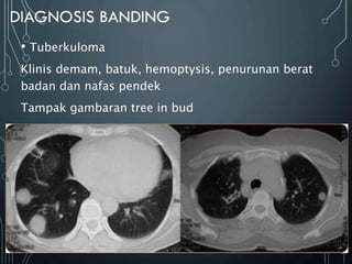 • Tuberkuloma
Klinis demam, batuk, hemoptysis, penurunan berat
badan dan nafas pendek
Tampak gambaran tree in bud
 