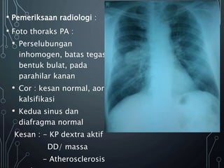 • Pemeriksaan radiologi :
• Foto thoraks PA :
• Perselubungan
inhomogen, batas tegas,
bentuk bulat, pada
parahilar kanan
• Cor : kesan normal, aorta
kalsifikasi
• Kedua sinus dan
diafragma normal
Kesan : - KP dextra aktif
DD/ massa
- Atherosclerosis
 