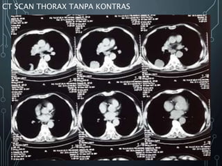 CT SCAN THORAX TANPA KONTRAS
 