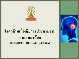 โรคกล้ามเนื้อเสียการประสานงาน
จากสมองน้อย
(SPINOCEREBELLAR ATAXIA)
 