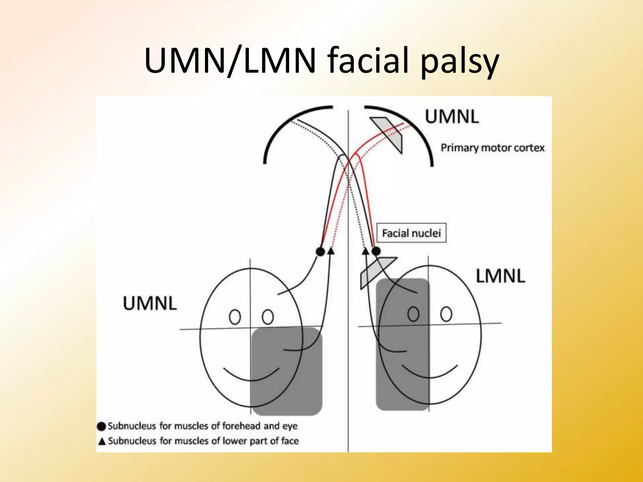 UMN/LMN facial palsy
 