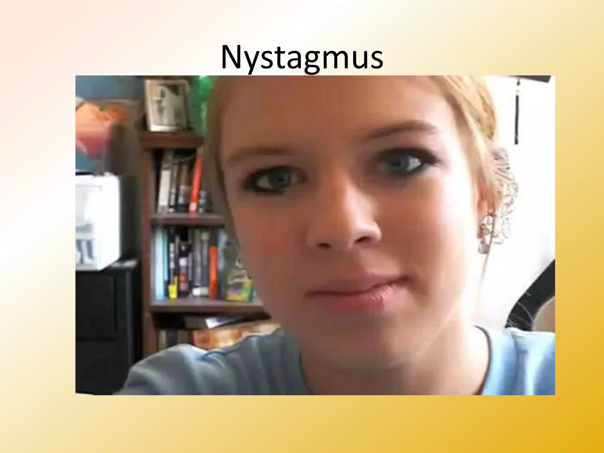 Nystagmus
 