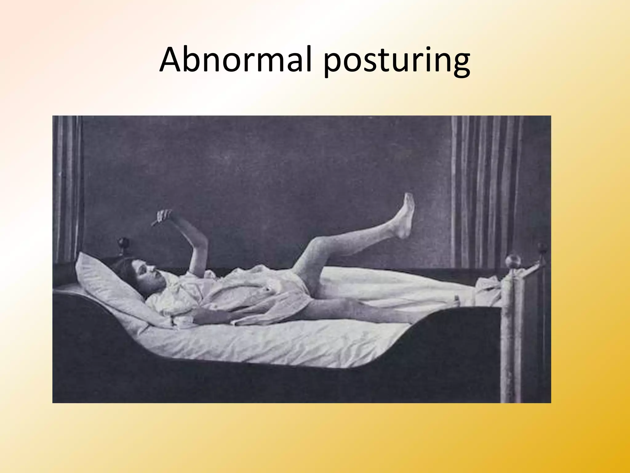 Abnormal posturing
 