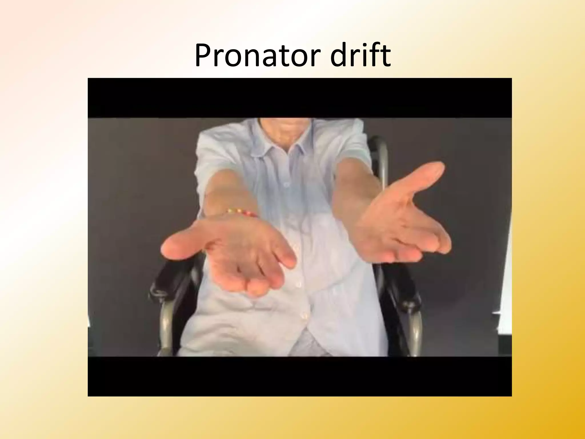 Pronator drift
 