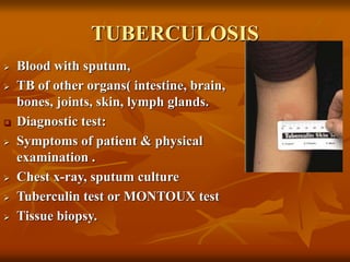 TUBERCULOSIS
 Blood with sputum,
 TB of other organs( intestine, brain,
bones, joints, skin, lymph glands.
 Diagnostic test:
 Symptoms of patient & physical
examination .
 Chest x-ray, sputum culture
 Tuberculin test or MONTOUX test
 Tissue biopsy.
 