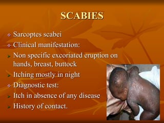 SCABIES
 Sarcoptes scabei
 Clinical manifestation:
 Non specific excoriated eruption on
hands, breast, buttock
 Itching mostly in night
 Diagnostic test:
 Itch in absence of any disease
 History of contact.
 