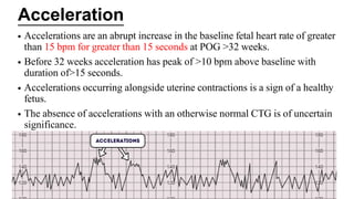 • Accelerations are an abrupt increase in the baseline fetal heart rate of greater
than 15 bpm for greater than 15 seconds at POG >32 weeks.
• Before 32 weeks acceleration has peak of >10 bpm above baseline with
duration of>15 seconds.
• Accelerations occurring alongside uterine contractions is a sign of a healthy
fetus.
• The absence of accelerations with an otherwise normal CTG is of uncertain
significance.
Acceleration
 