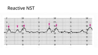 Nst Names NST CTG-2.pptx this helps in understanding the nst and ctg monitoring ...
