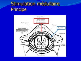 12/08/11 Stimulation médullaire Principe 