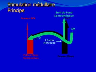 12/08/11 Petites Fibres  Nociceptives Tact Grosses Fibres SM Bruit de Fond Somesthésique Lésion Nerveuse Douleur   Stimulation médullaire Principe 