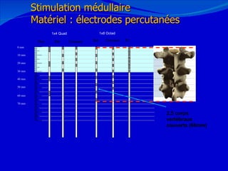12/08/11 Stimulation médullaire Matériel : électrodes percutanées 0 mm 10 mm 20 mm 30 mm 40 mm 50 mm 60 mm 70 mm Std Plus Std Compact Compact SC 1x4 Quad 1x8 Octad 2,5 corps vertébraux couverts (66mm) 