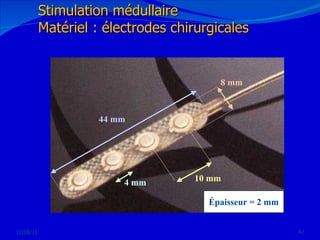 12/08/11 Stimulation médullaire Matériel : électrodes chirurgicales 
