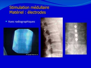 Vues radiographiques 12/08/11 Stimulation médullaire Matériel : électrodes 
