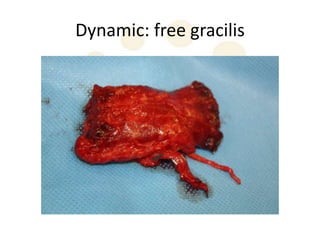 Dynamic: free gracilis
 