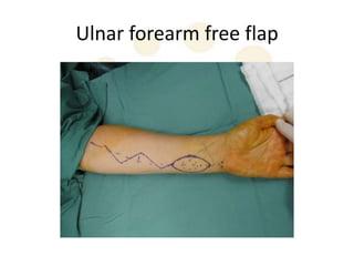 Ulnar forearm free flap
 