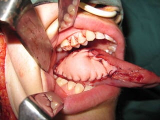 Nsw speech-path-talk-flapvs-grafts