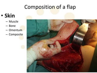 Composition of a flap
• Skin
  –   Muscle
  –   Bone
  –   Omentum
  –   Composite
 