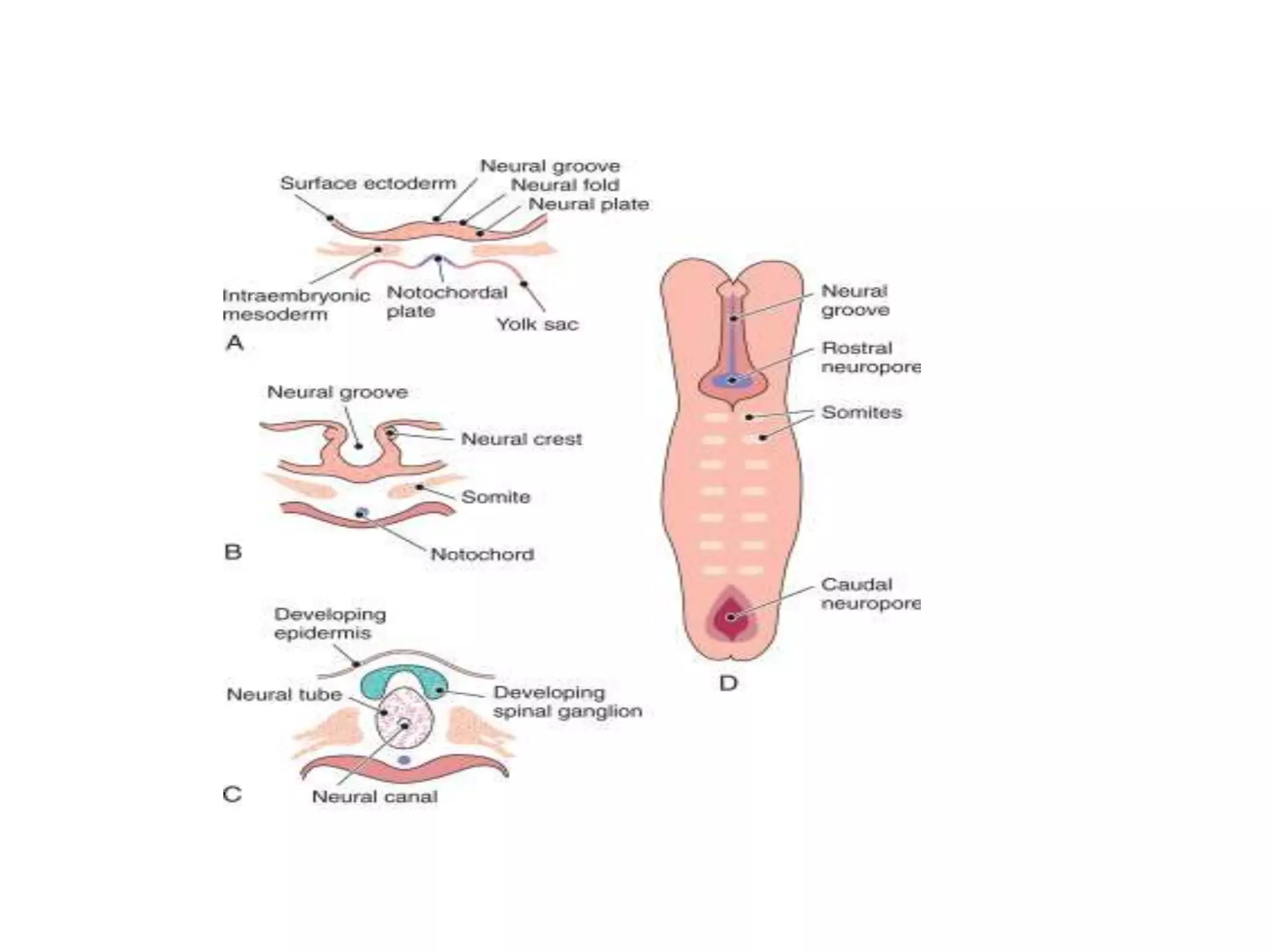neural tube defects | PPTX