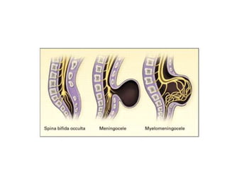 neural tube defects | PPTX