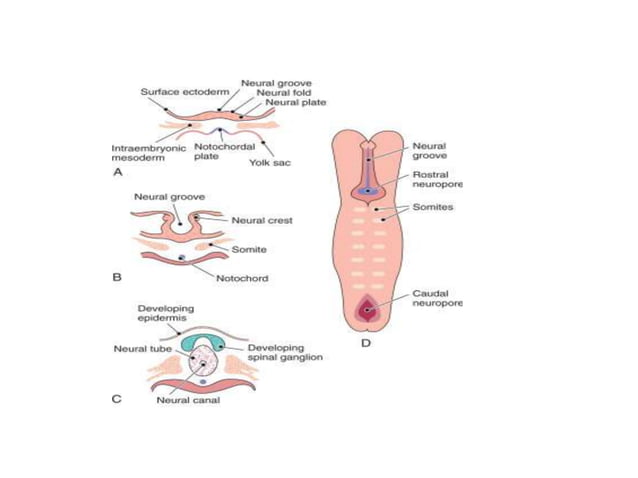 Neutral Defects neural tube defects | PPTX | Brain and Nervous System Disorders ...