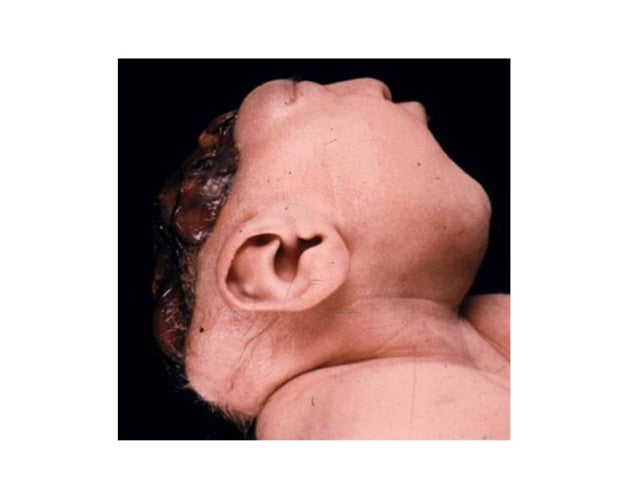 neural tube defects