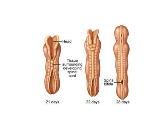 neural tube defect