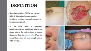 DEFINITION
• Neural tube defects (NTDs) are a group
of birth defects in which an opening
in spine or cranium remains from early in
human development.
• In the third week of pregnancy
called gastrulation, specialized cells on the
dorsal side of the embryo begin to change
shape and form the neural tube. When the
neural tube does not close completely, an
NTD develops.
 