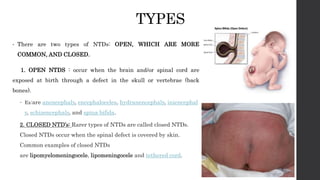 TYPES
• There are two types of NTDs: OPEN, WHICH ARE MORE
COMMON, AND CLOSED.
1. OPEN NTDS : occur when the brain and/or spinal cord are
exposed at birth through a defect in the skull or vertebrae (back
bones).
 Ex:are anencephaly, encephaloceles, hydranencephaly, iniencephal
y, schizencephaly, and spina bifida.
2. CLOSED NTD’s: Rarer types of NTDs are called closed NTDs.
Closed NTDs occur when the spinal defect is covered by skin.
Common examples of closed NTDs
are lipomyelomeningocele, lipomeningocele and tethered cord.
 
