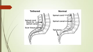 Neural tube defects - in neonates and children | PDF