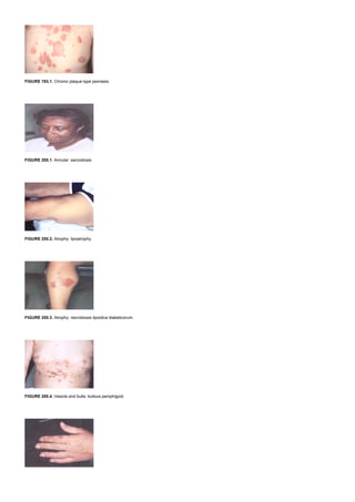 FIGURE 193.1. Chronic plaque-type psoriasis.
FIGURE 200.1. Annular: sarcoidosis.
FIGURE 200.2. Atrophy: lipoatrophy.
FIGURE 200.3. Atrophy: necrobiosis lipoidica diabeticorum.
FIGURE 200.4. Vesicle and bulla: bullous pemphigoid.
 