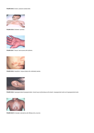 FIGURE 200.5. Erosion: porphyria cutanea tarda.
FIGURE 200.6. Exfoliation: psoriasis.
FIGURE 200.7. Fissure: hand eczema with erythema.
FIGURE 200.8. Herpetiform: herpes simplex with umbilicated vesicles.
FIGURE 200.9. Hyperpigmentation/hypopigmentation: discoid lupus erythematosus with atrophic, hypopigmented center and hyperpigmented border.
FIGURE 200.10. Indurated: scleroderma with diffusely shiny, taut skin.
 