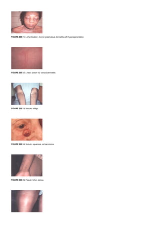 FIGURE 200.11. Lichenification: chronic eczematous dermatitis with hyperpigmentation.
FIGURE 200.12. Linear: poison ivy contact dermatitis.
FIGURE 200.13. Macule: vitiligo.
FIGURE 200.14. Nodule: squamous cell carcinoma.
FIGURE 200.15. Papule: lichen planus.
 
