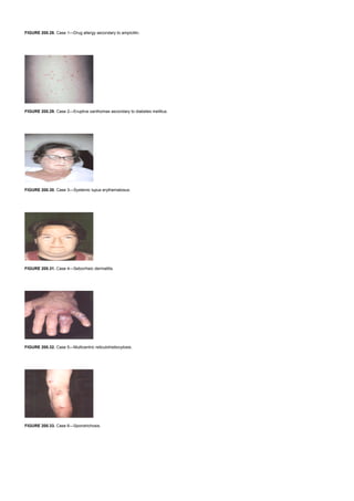 FIGURE 200.28. Case 1—Drug allergy secondary to ampicillin.
FIGURE 200.29. Case 2—Eruptive xanthomas secondary to diabetes mellitus.
FIGURE 200.30. Case 3—Systemic lupus erythematosus.
FIGURE 200.31. Case 4—Seborrheic dermatitis.
FIGURE 200.32. Case 5—Multicentric reticulohistiocytosis.
FIGURE 200.33. Case 6—Sporotrichosis.
 