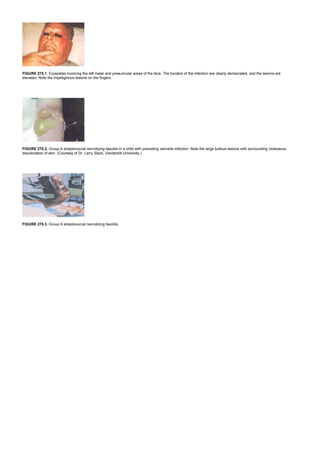 FIGURE 275.1. Erysipelas involving the left malar and preauricular areas of the face. The borders of the infection are clearly demarcated, and the lesions are
elevated. Note the impetiginous lesions on the fingers.
FIGURE 275.2. Group A streptococcal necrotizing fasciitis in a child with preceding varicella infection. Note the large bullous lesions with surrounding violaceous
discoloration of skin. (Courtesy of Dr. Larry Slack, Vanderbilt University.)
FIGURE 275.3. Group A streptococcal necrotizing fasciitis.
 