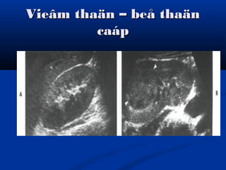 Vieâm thaän – beå thaänVieâm thaän – beå thaän
caápcaáp
 