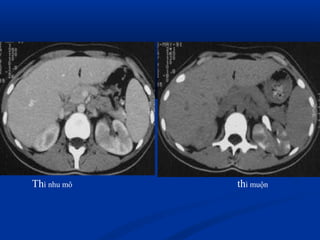 Thì nhu mô thì muộn
 