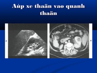 Aùp xe thaän vaø quanhAùp xe thaän vaø quanh
thaänthaän
 