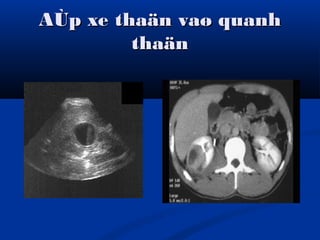 AÙp xe thaän vaø quanhAÙp xe thaän vaø quanh
thaänthaän
 