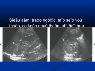 - Sieâu aâm: traøo ngöôïc, taïo seïo voûSieâu aâm: traøo ngöôïc, taïo seïo voû
thaän, co keùo nhuù thaän, phì ñaïi buøthaän, co keùo nhuù thaän, phì ñaïi buø
tröø khu truù..tröø khu truù..
 