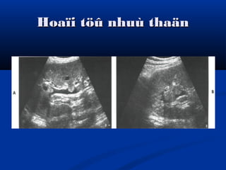 Hoaïi töû nhuù thaänHoaïi töû nhuù thaän
 