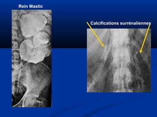 Rein Mastic
Calcifications surrénaliennes
 