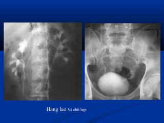 Hang lao và chít hẹp
 